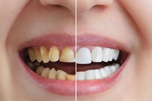 بلیچینگ دندان